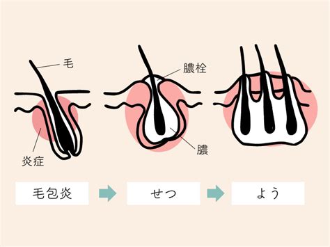 デリケートゾーン(陰部)のできもの｜ニキビ・しこり 